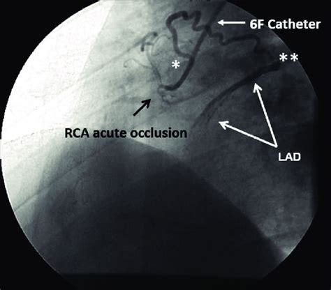 rca results